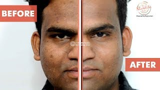 चेहरे के दाग धब्बे, पिंपल और चोट के निशान हटाने का laser इलाज | Dealing with photoaging & dark spots