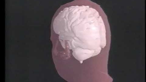 3D Reconstruction of MRI images