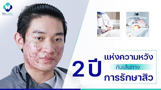 รักษาสิว | โครงการรักษาสิวฟรี Season 4 | EP.2 | 2 ปีแห่งความหวัง กับเส้นทางการรักษาสิว | BSL Clinic