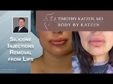 Removal of Illegal Silicone Injections from the Lips plus Liposuction