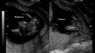 Hayley and Ivan's baby's ultrasound video - 13 weeks  He has hiccups