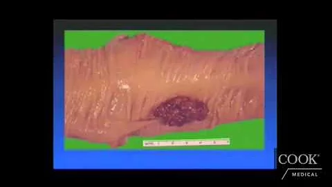 Best Protection Against Colon Cancer