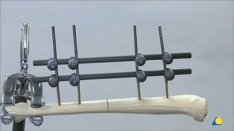 Tibia, Shaft - Fracture - Stabilization with Different External Fixator Frame Constructs