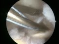 Rotator cuff repair  surgery  orthopedic surgeon dr alejandro badia  part 1