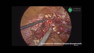 TLH with Pseudo Broad Ligament Myoma