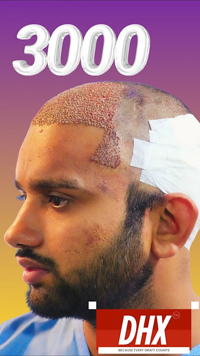 Natural Best Hair Transplant Results in Mumbai | DHX Technique