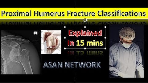 Proximal Humerus Fracture Classification Simplified | Neer’s Classification Explained | ASAN Network