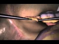 LapSim Appendectomy Single Stapling