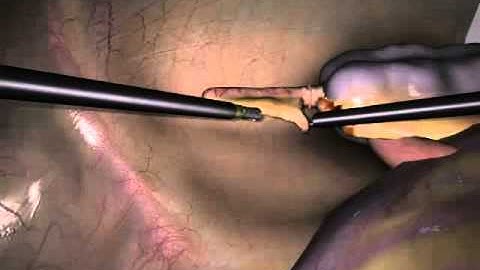 LapSim Appendectomy Single Stapling