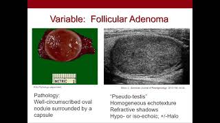 Thyroid Nodules What We Know and What We Don't Ultrasound Video