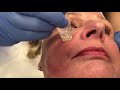 The yps gold filltox facial  dr  anthony youn