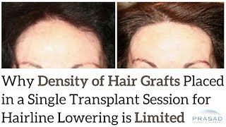 Why Hair Graft Density In A Single Hairline Lowering Session Is Limited To Ensure Graft Survival
