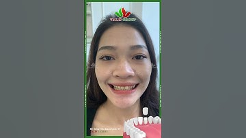 ✨THAY ĐỔI NỤ CƯỜI, THĂNG HẠNG NHAN SẮC✨#short #reels #tiktok #trend #trending #beauty