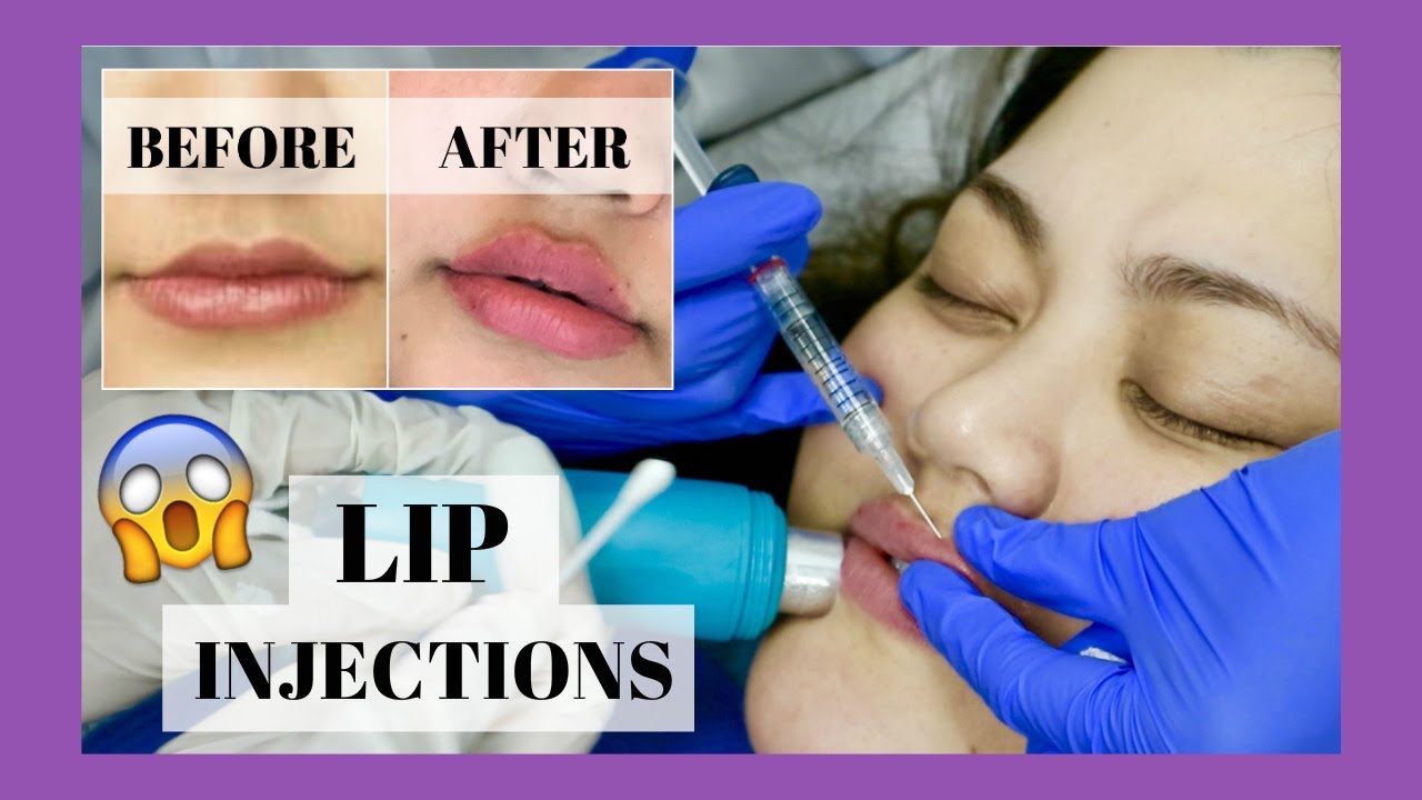 GETTING LIP INJECTIONS IN THE PHILIPPINES AngKikayKo YouTube
