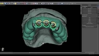 Full Blue Sky Plan Training Tutorial  Surgical Guide Drill Stops News