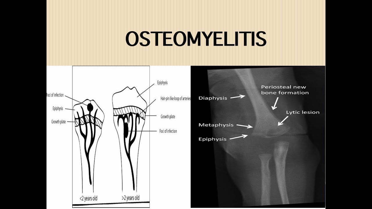 Acute Osteomyelitis YouTube