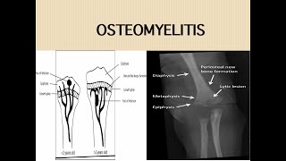 Acute Osteomyelitis screenshot 5