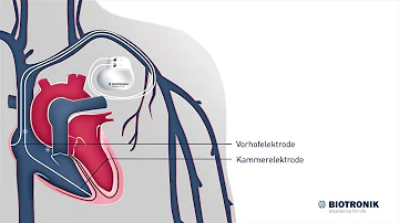 Was sind die besten Herzschrittmacher?