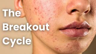 Why Your Breakouts Get WORSE When You Try To Fix Them