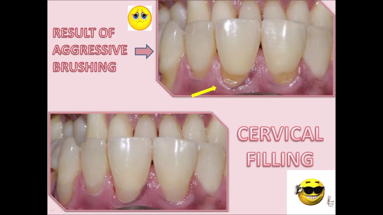 Smile Designing at Coimbatore | Digital Smile Designing | Tooth Town Dental Clinic, Nava India