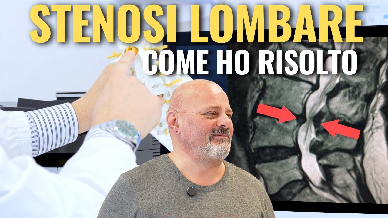 Stenosi Lombare e Dorsale: Testimonianze Vere su Sintomi, Intervento e Recupero