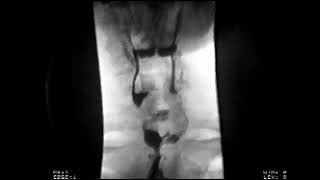 "Ken's" Modified Barium Swallow Study - Michael Groher | MedBridge