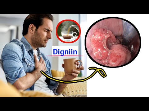 Kansarka Dhuunta Iyo Tubada Cuna Mareenka Iyo Calaamadaha Lagu Garto