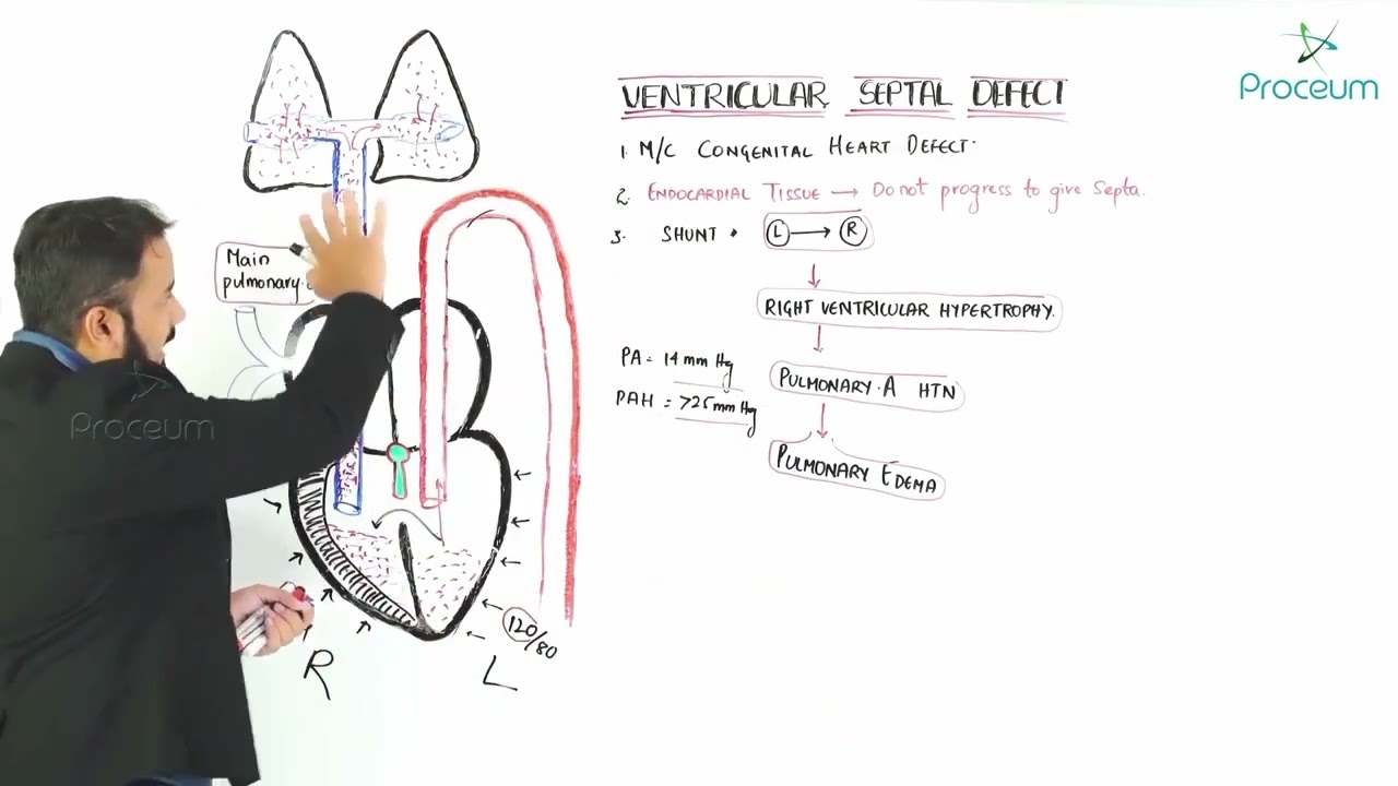 What Is EISENMENGER SYNDROME YouTube what-is-eisenmenger-syndrome-youtube