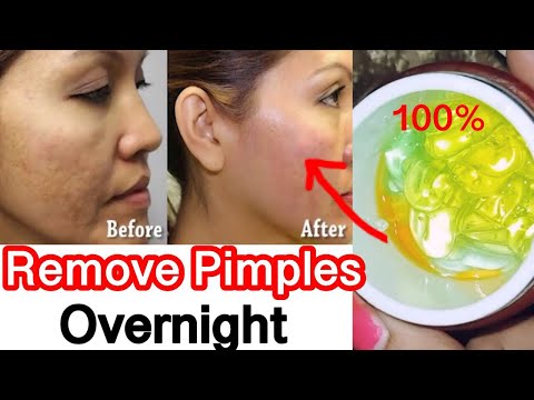 How to Remove Pimples, Acne Marks, Acne Pits in  day | Natural Remedy for Pimples #JSuperkaur