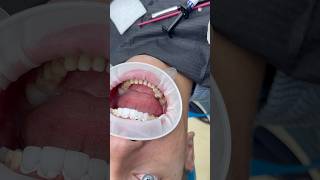 Cimentare coroane dentare emax