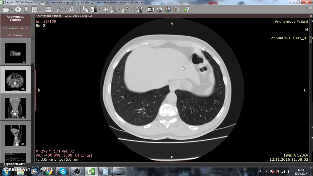 CT Abdomen Nativ Harnleiterstein Mit Nephritis YouTube Ct abdomen nativ harnleiterstein mit nephritis youtube