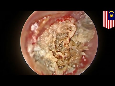 วีดีโอ: โรคหูน้ำหนวกเรื้อรัง (การติดเชื้อที่หู) และขั้นตอนการผ่าตัดที่เราเรียกว่า TECA
