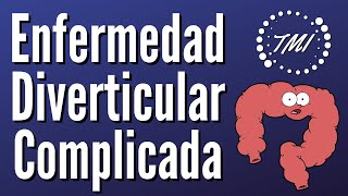 Enfermedad Diverticular Complicada Explicada Claramente