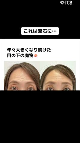 【クマ取り】これは流石に… #shorts