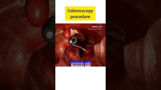 colonoscopy procedure with the help of 3d animation #trending