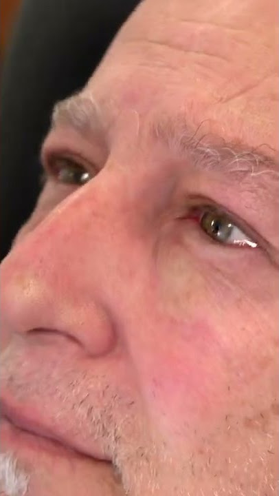 Stent Removal After Lacrimal Tear Duct Surgery