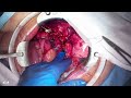 Open Whipple Procedure