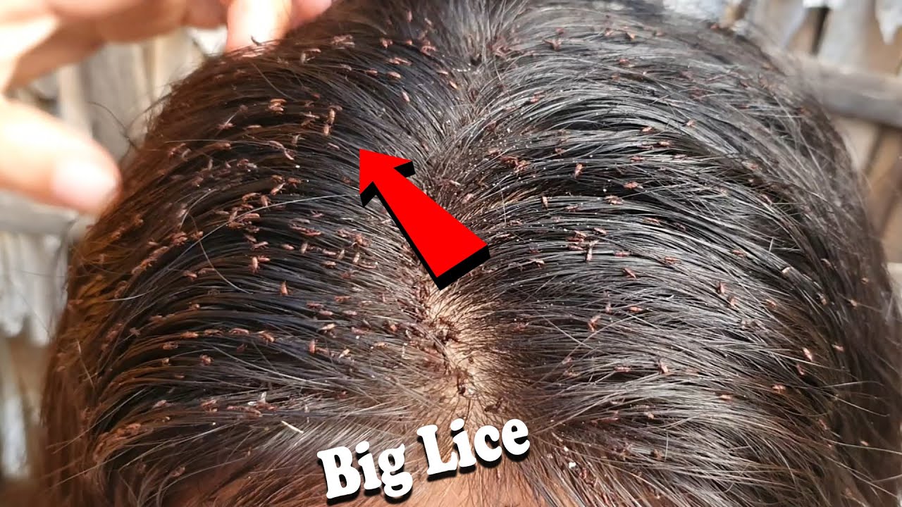 Dry hair lice combing Giant Lice Removal YouTube