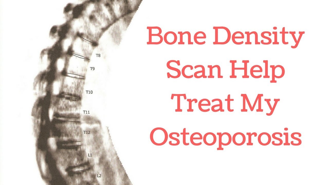 Will a Bone Density Scan Help Treat My Osteoporosis 