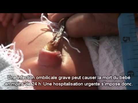 Infection Ombilicale Du Nourisson Legendes En Francais Youtube