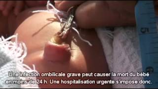 Comment Savoir Si Le Cordon Ombilical Est Infecte Reviews Wiki Source 1 Des Informations Tests Chroniques Avis Et Nouveautes Comment Savoir Si Le Cordon Ombilical Est Infecte Reviews Wiki Source 1 Des Informations Tests Chroniques Avis Et Nouveautes