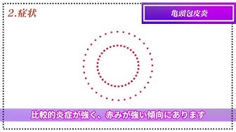 亀頭包皮炎市販薬 Youtube