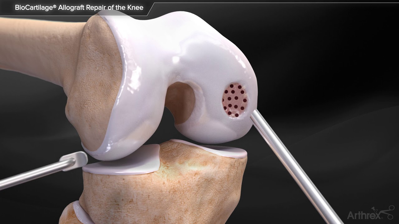 orthopedic disability BioCartilage® Allograft Repair of the Knee