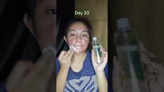 My Acne Journey Day 1-50 Using Centella Asiatica Premium Set From Her Choice Ph