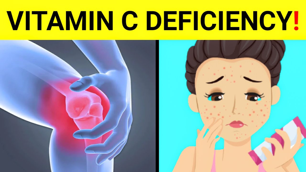 case study of vitamin c deficiency