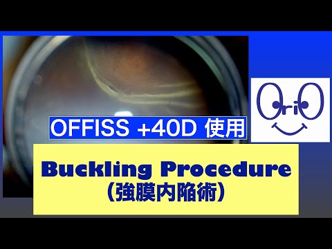 Buckling Procedure for Rhagmatogenous Retinal Detachment using OFFISS裂孔原性網膜剥離に対する網膜復位術（強膜内陥術）