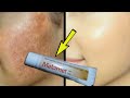 Melamet Cream How To Use | Detail Review in Hindi | Melamet Cream Remove Pigmentation | Melasma |