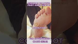 CORN SCRAPPING #callus #callusremoval #cornfoot #cornsandcalluses #podiatrist #scrapping #footcare