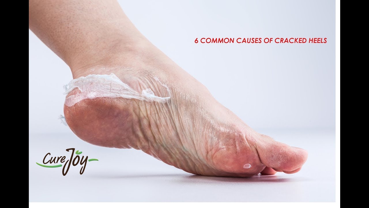 What Causes Cracked Heels recommendations What Causes Cracked Heels advise