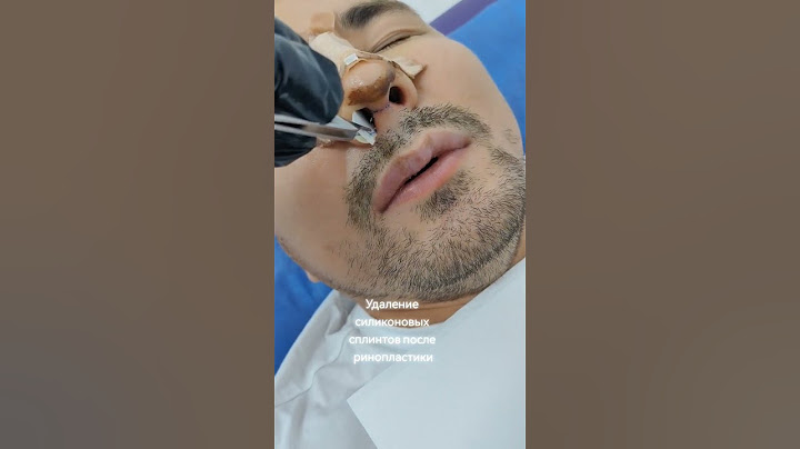 Силиконовый сплинт. Септопластика. Septoplasty